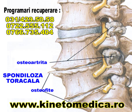 osteoartrita vertebrelor)